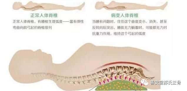 腰間盤突出墊小米袋好處多多
